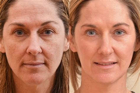 Which Laser Skin Resurfacing Treatment Would Work Best For 